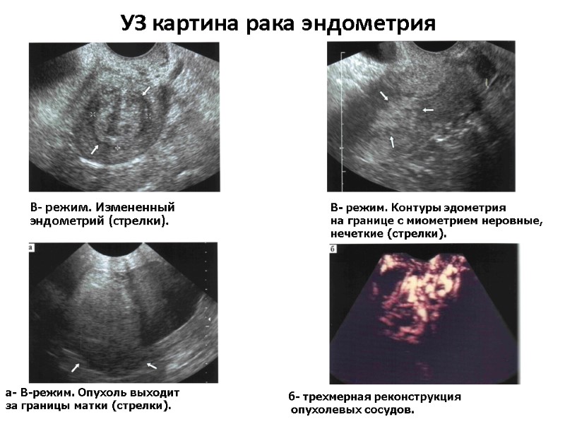 УЗ картина рака эндометрия В- режим. Измененный эндометрий (стрелки).  В- режим. Контуры эдометрия
